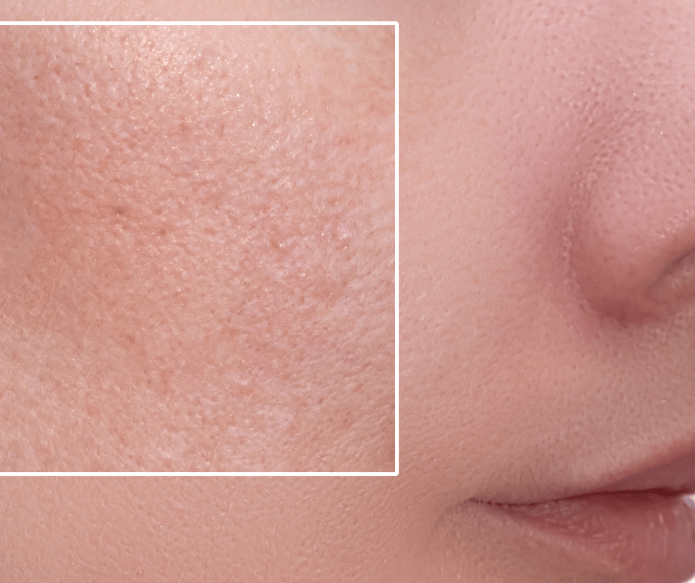 What Causes Enlarged Pores And How To Get Rid Of Them NassifMD Skincare what-causes-enlarged-pores-and-how-to-get-rid-of-them-nassifmd-skincare