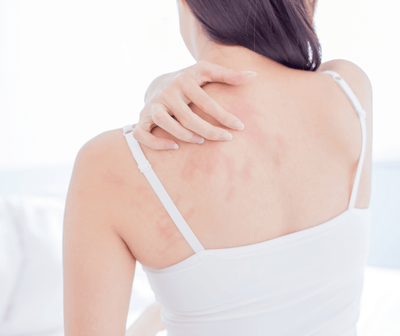 Home Remedies: What Can Relieve Itchy Eczema