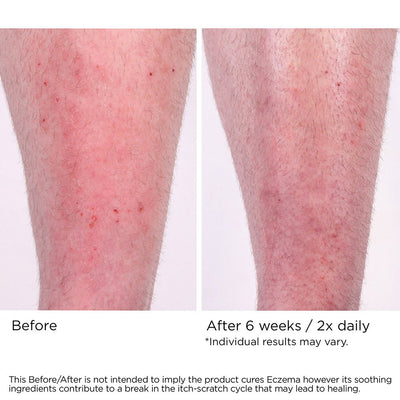 Eczema Cream - NassifMD® Skincare