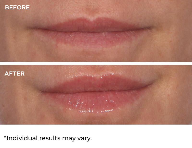 Hydro-Screen For Lips - NassifMD® Skincare